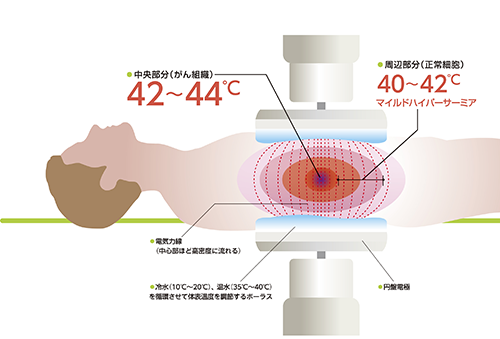 がん温熱療法ハイパーサーミア加温イメージ